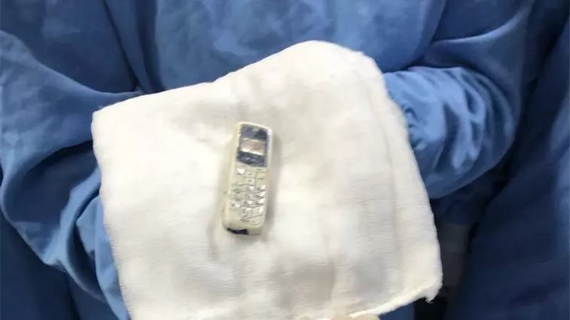 بعد 6 سنوات.. استخراج هاتف محمول من معدة مريض بمستشفى الباطنة بجامعة المنصورة