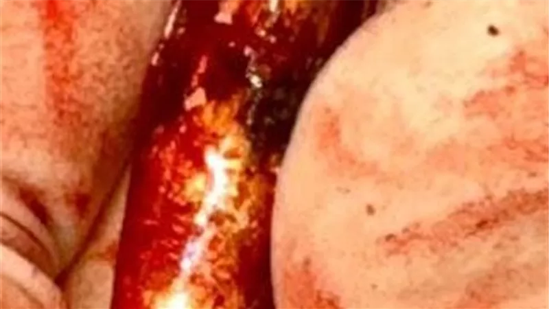إنجاز طبي نادر بجامعة الإسكندرية لإنقاذ مصاب فلسطيني من غزة