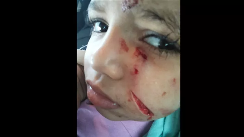 كلب ضال يعقر طفلة بحدائق الأهرام ويشوه وجهها.. والأسرة تناشد إنقاذها وإجراء جراحة تجميلية